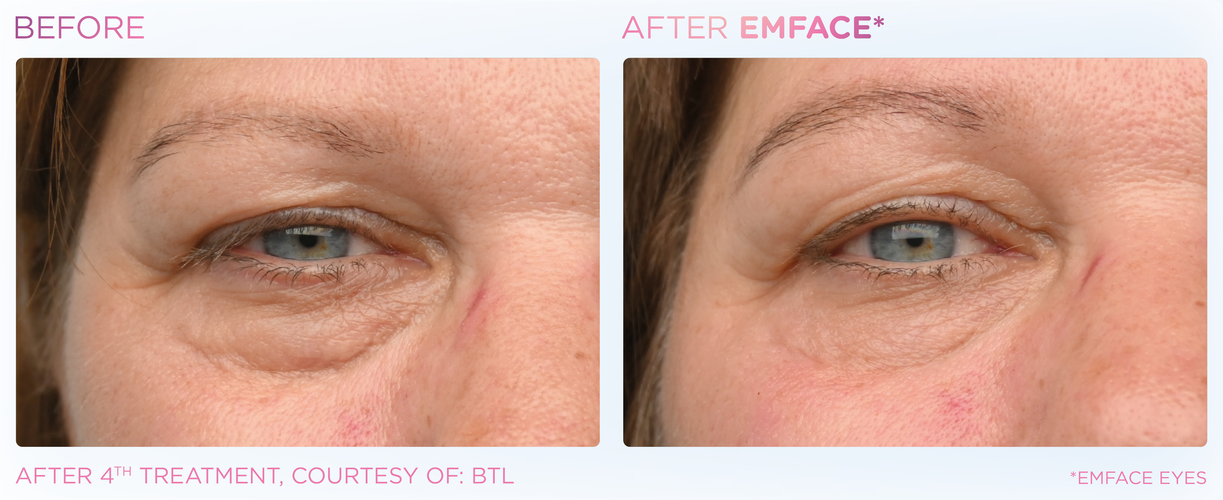 Emface Results for the Eyes