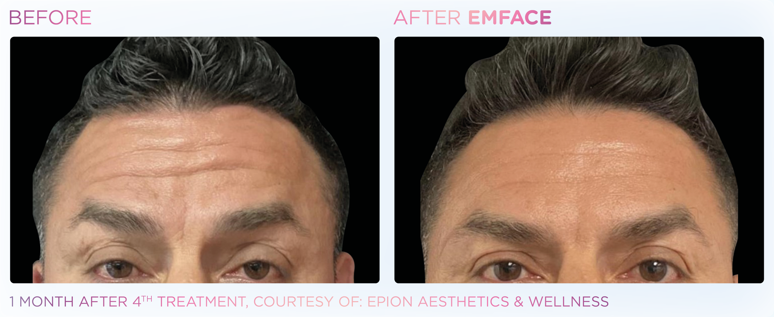 Emface Results for the Forehead