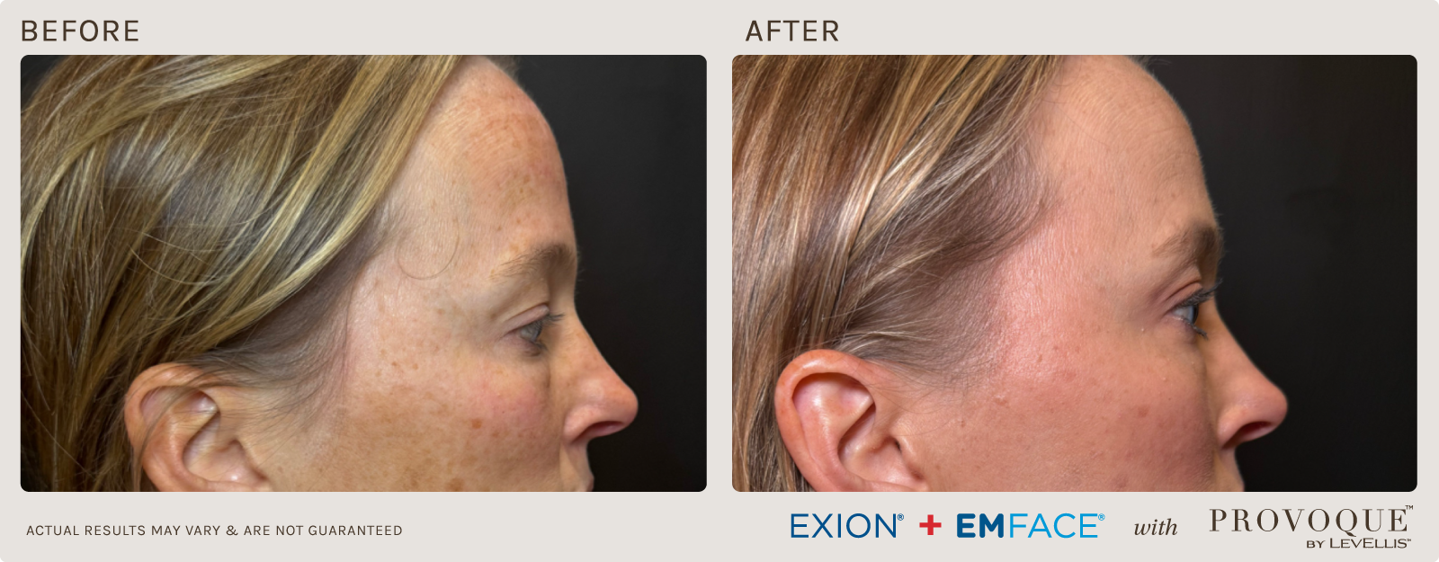 Provoque results paired with Emface & Exion treatments.