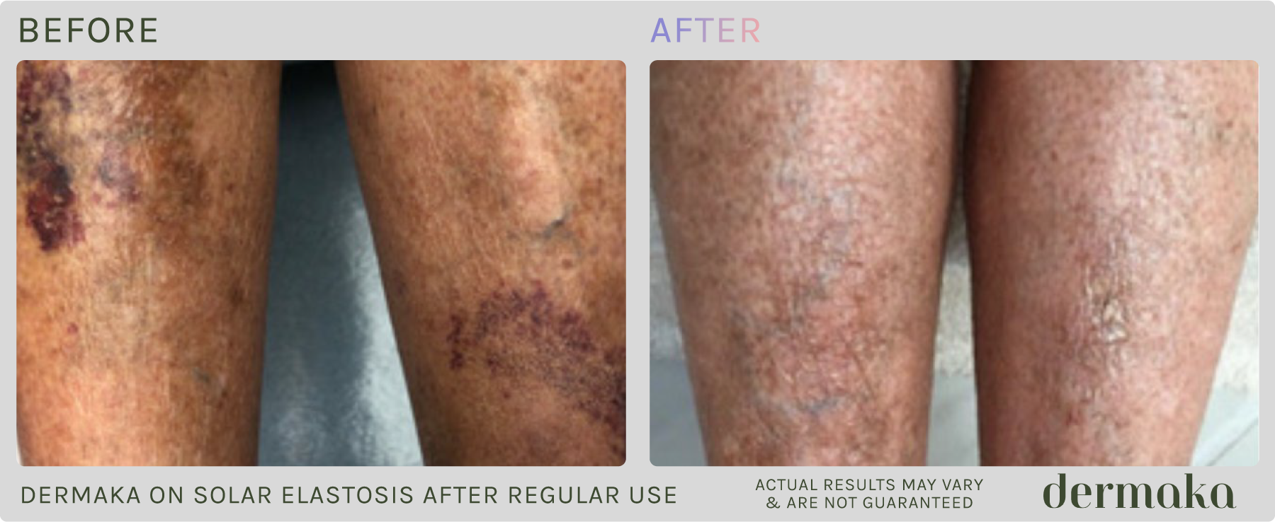 Dermaka On Solar Elastosis After Regular Use