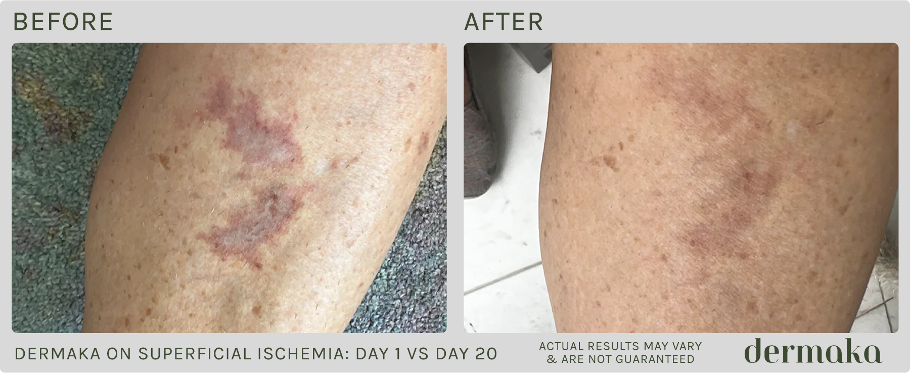 Dermaka On Superficial Ischemia: Before/After