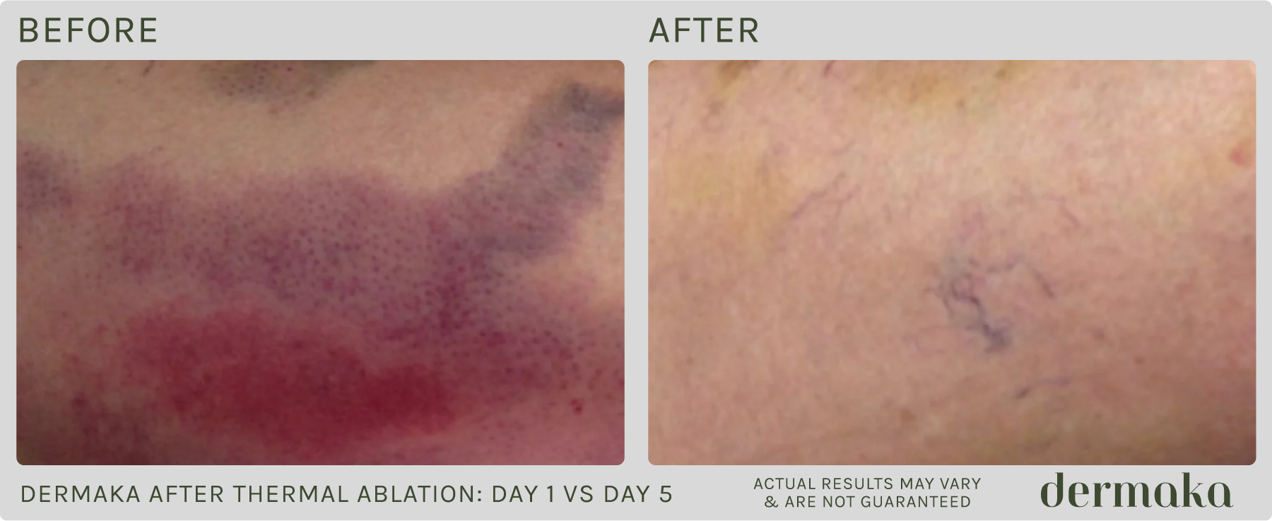 Dermaka After Thermal Ablation: Day 1 vs. Day 5