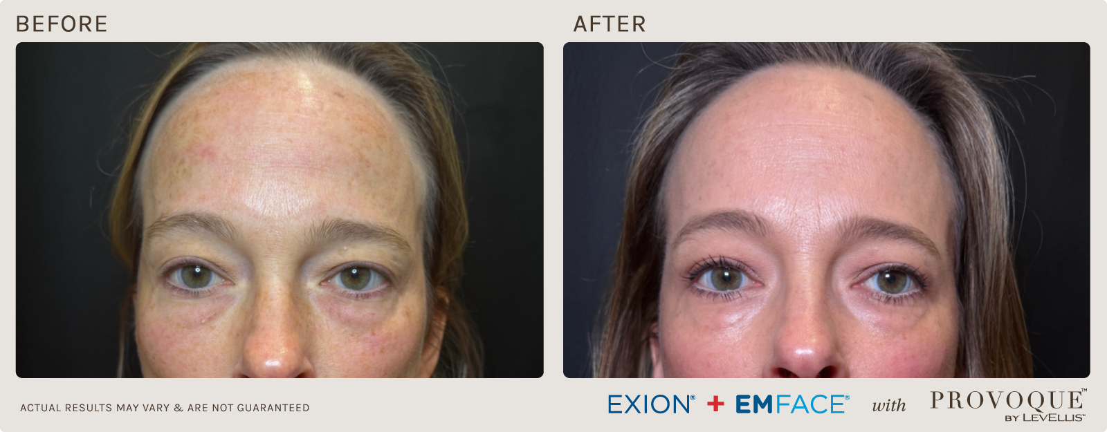 Provoque results paired with Emface & Exion treatments.