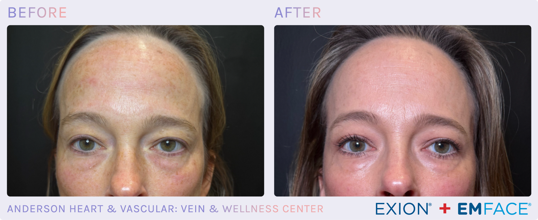 Emface Results for the Face