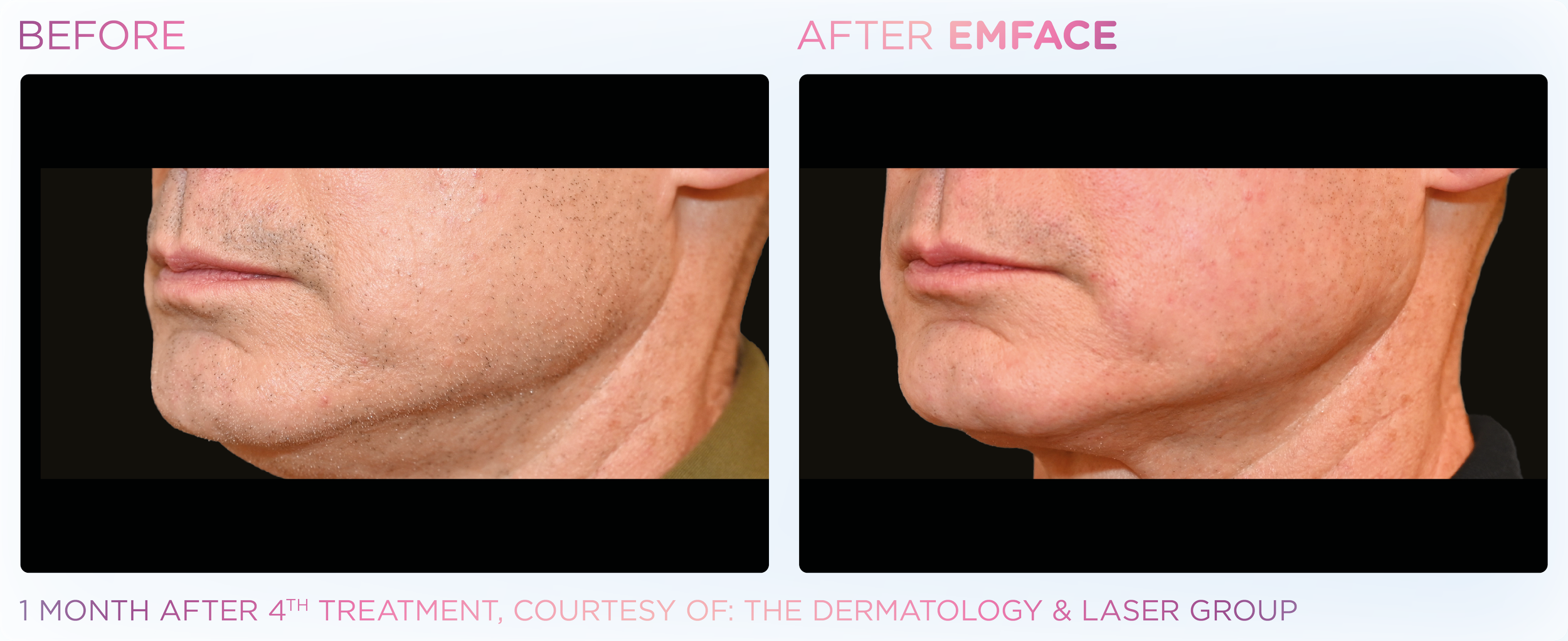 Emface Results for the Neck and Jawline