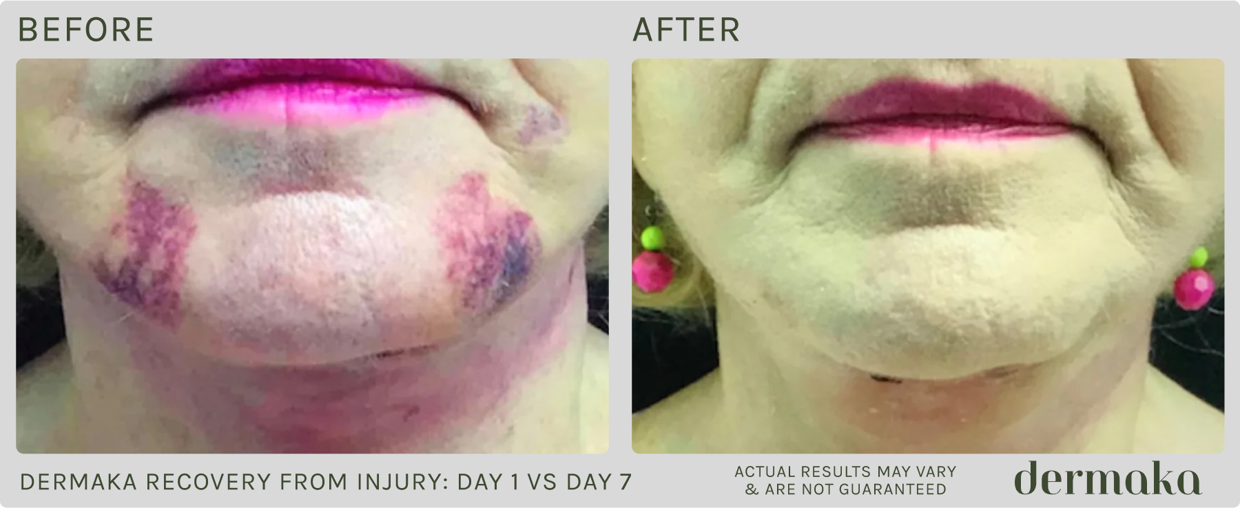Dermaka Recovery From Injury: Before/After