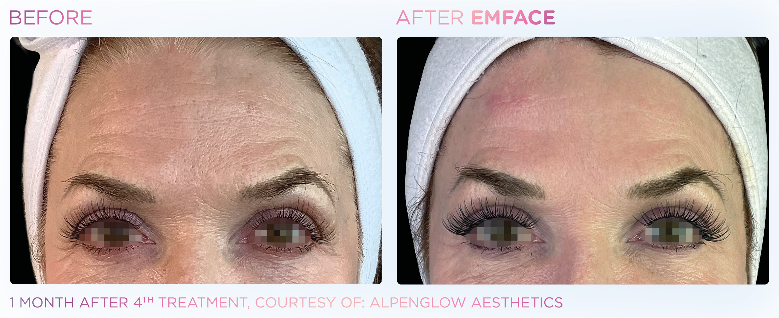 Emface Results for the Forehead