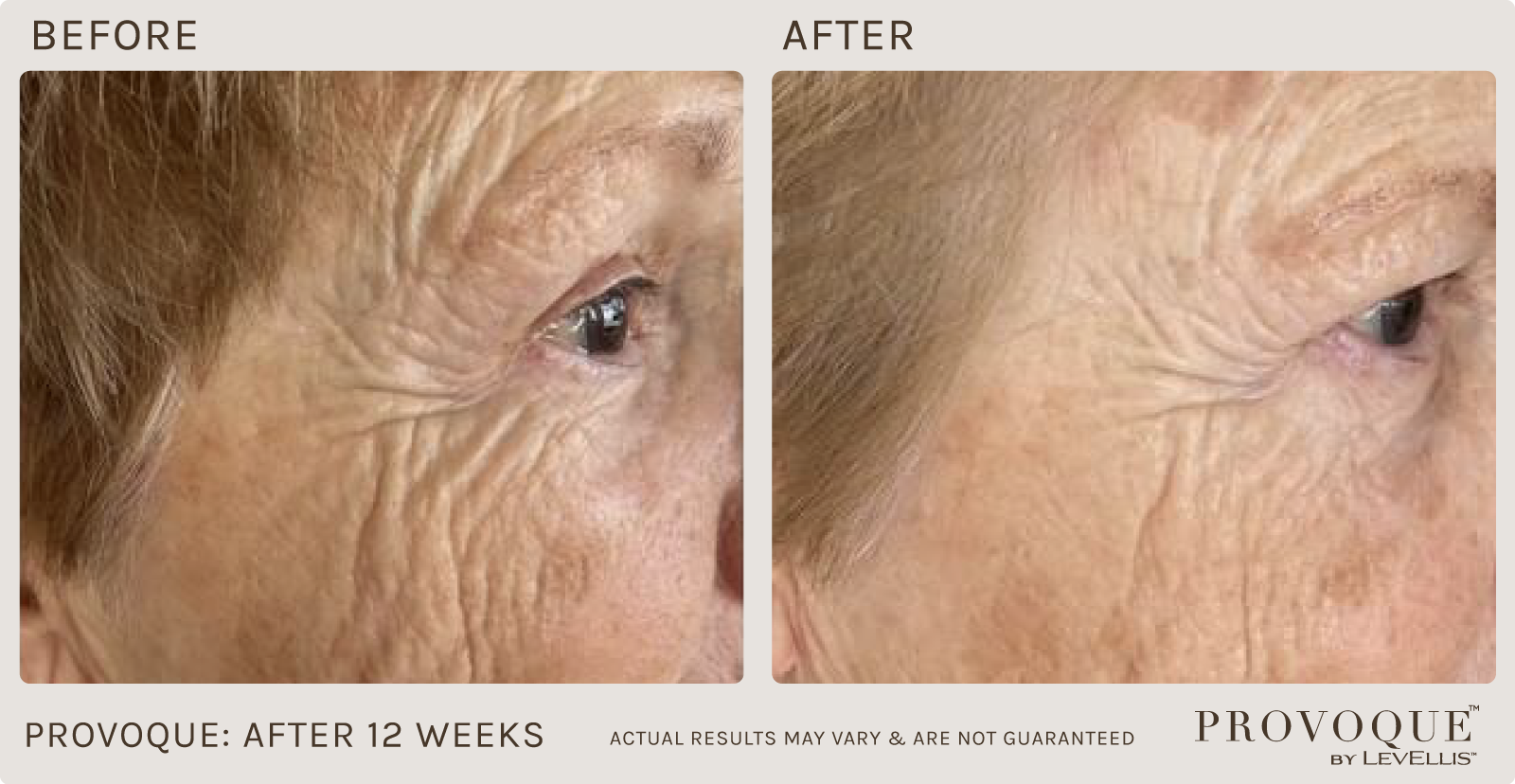 Provoque results after 12 weeks. 