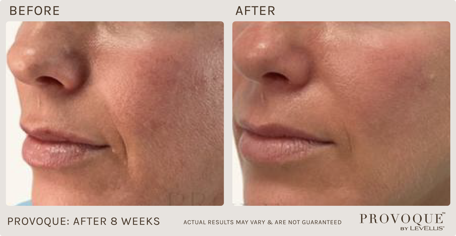 Provoque results after 8 weeks. 