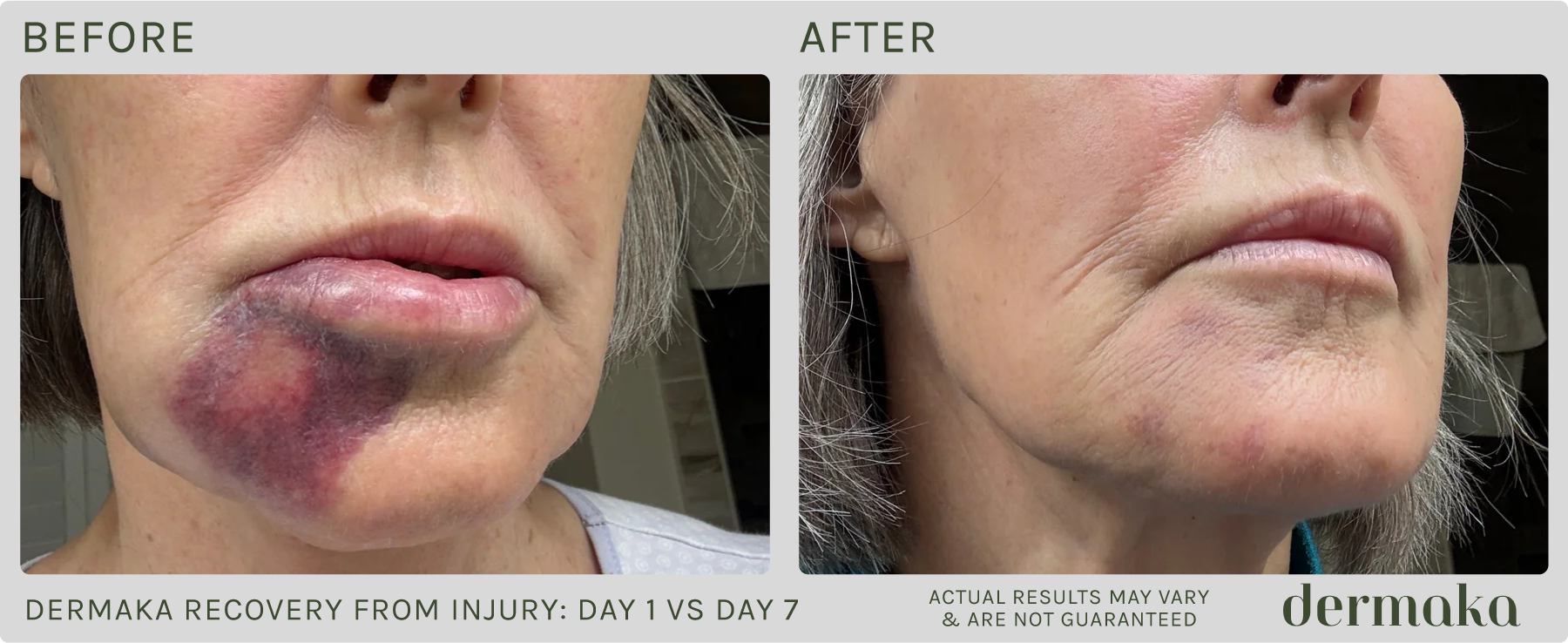 Dermaka Recovery From Injury: Before/After