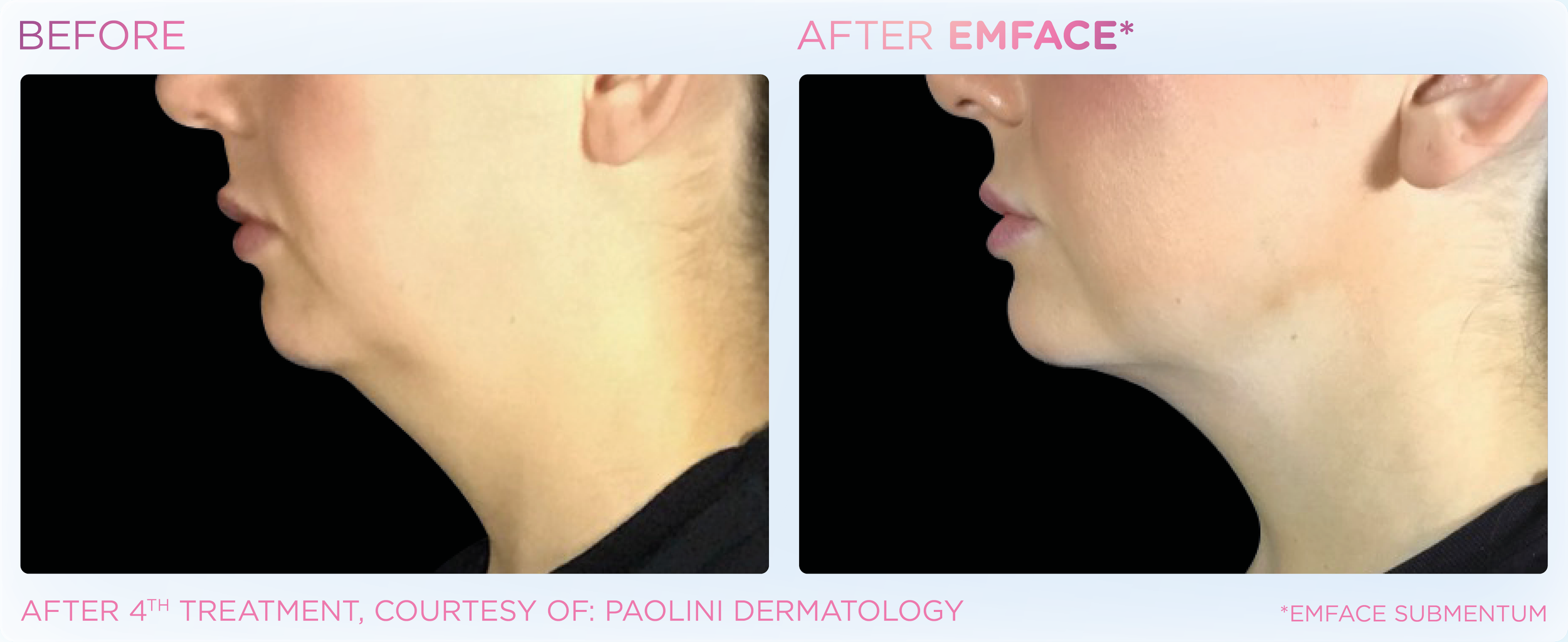 Emface Results for the Neck and Jawline