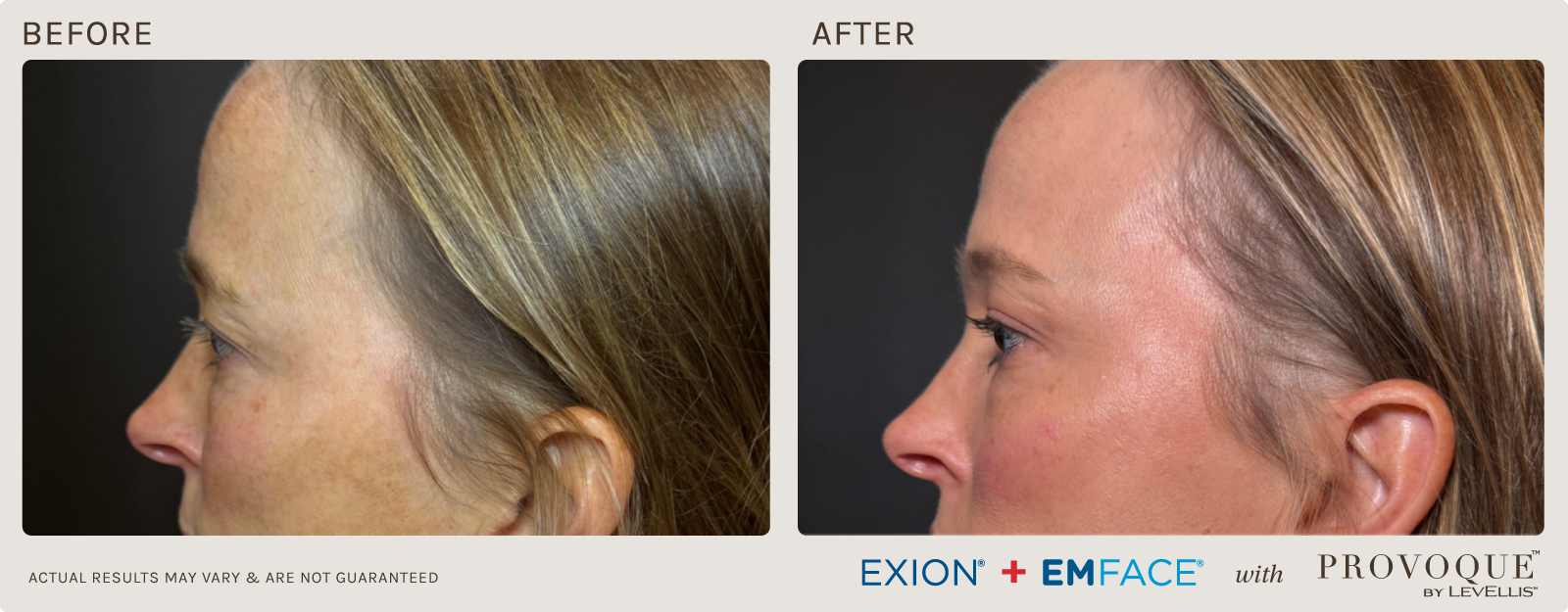 Provoque results paired with Emface & Exion treatments.