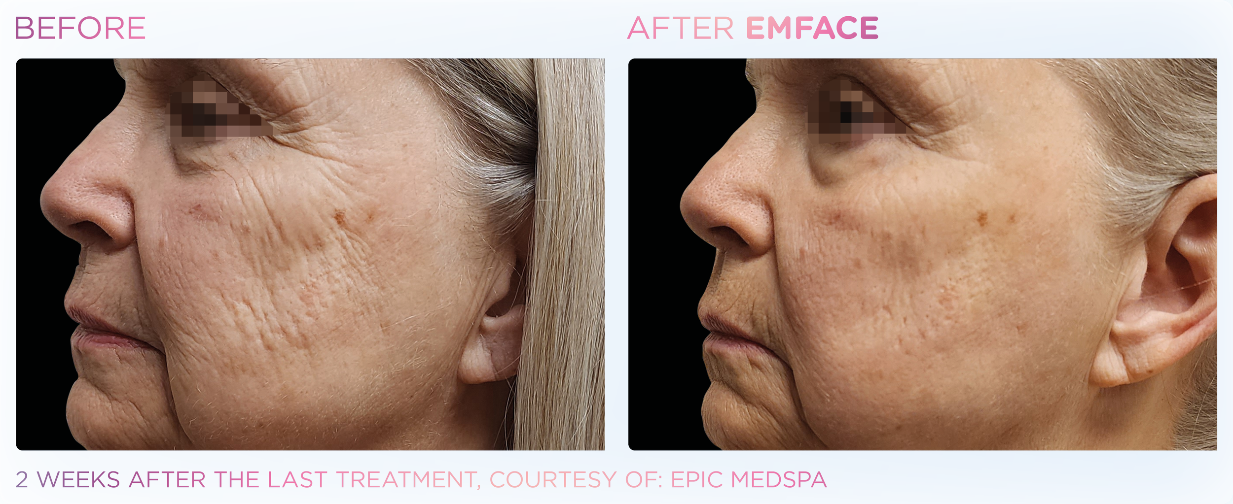 Emface Results for the Face
