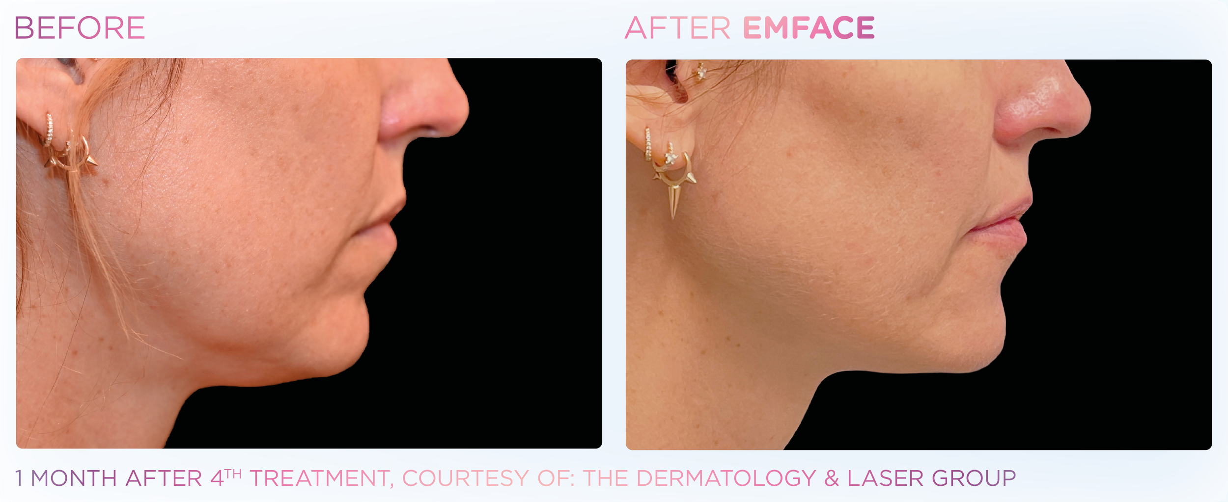Emface Results for the Neck and Jawline