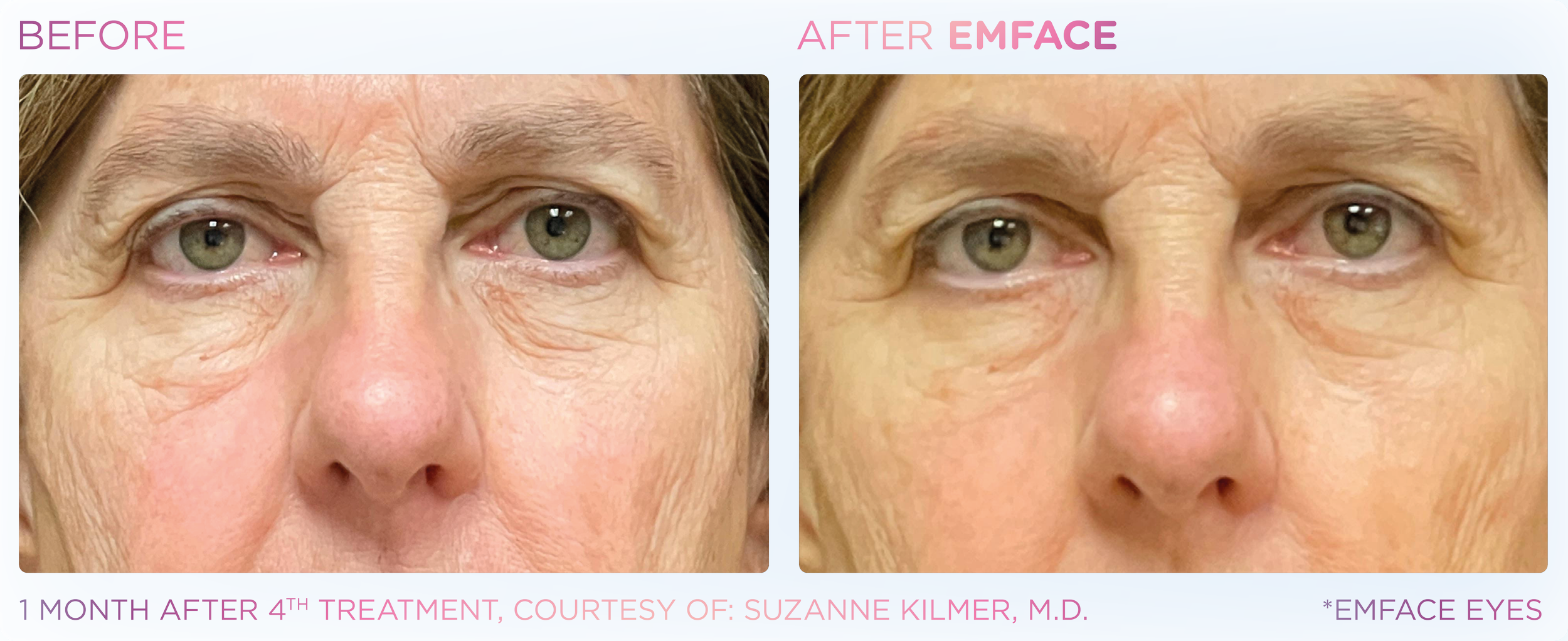 Emface Results for the Eyes