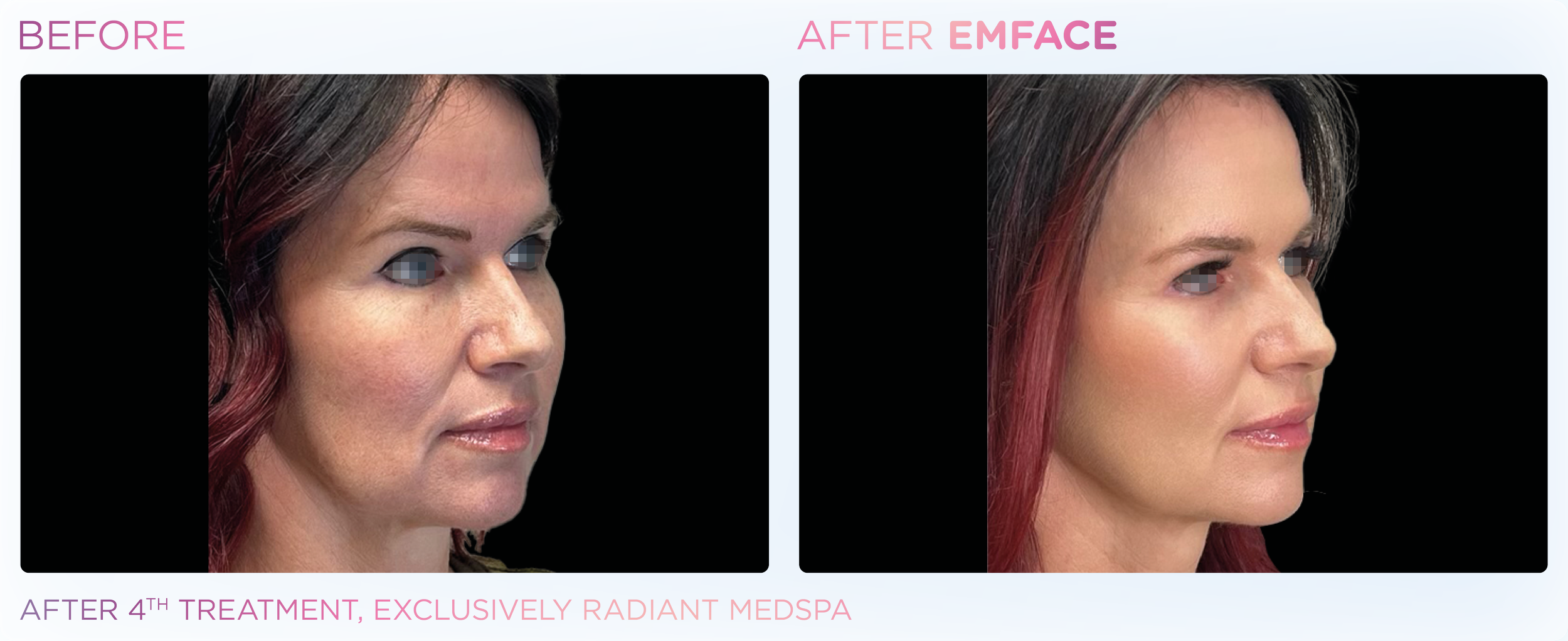 Emface Results for the Face