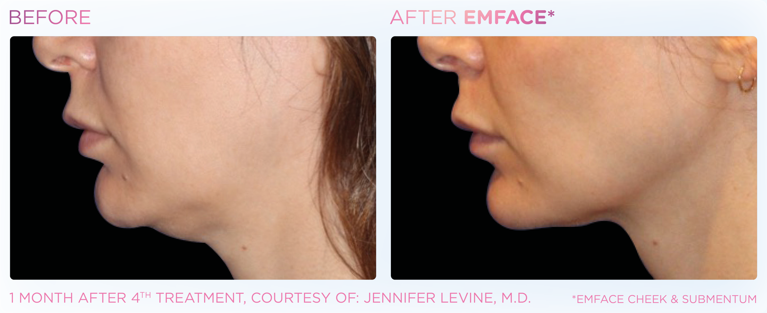 Emface Results for the Neck & Jawline