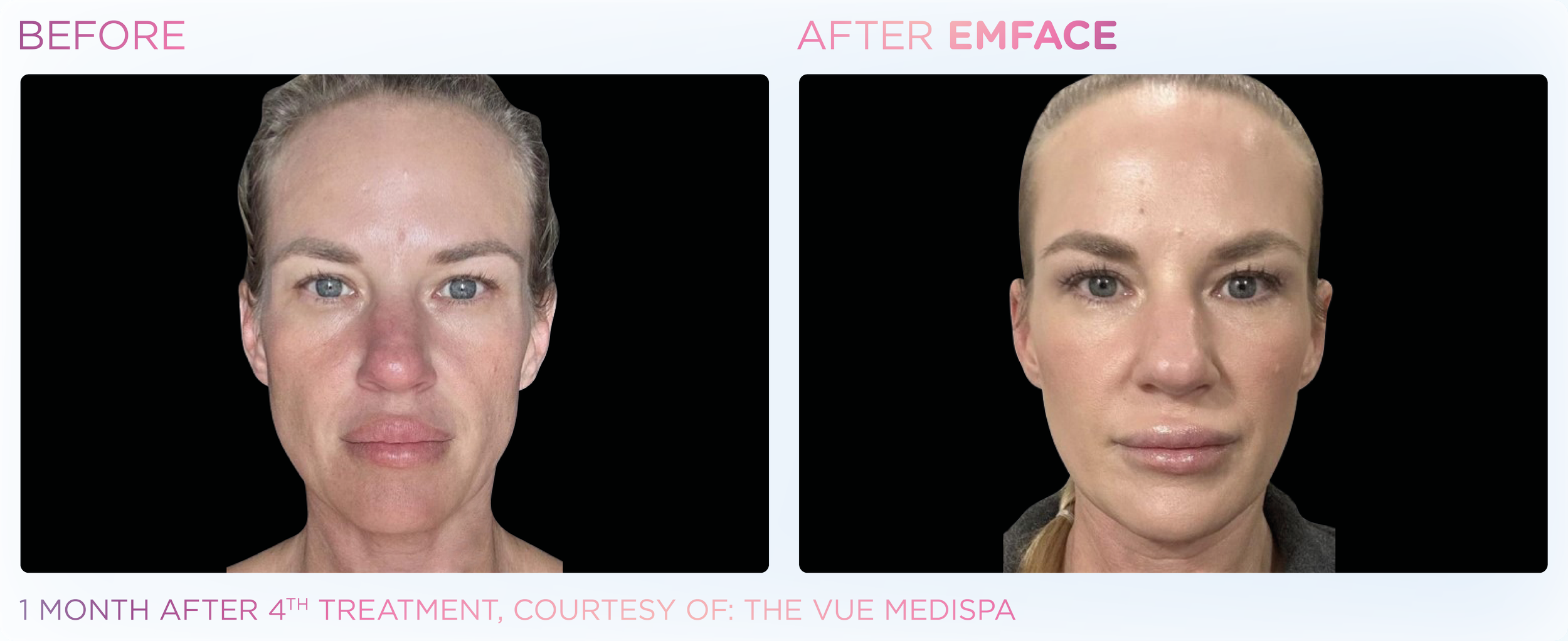 Emface Results for the Face