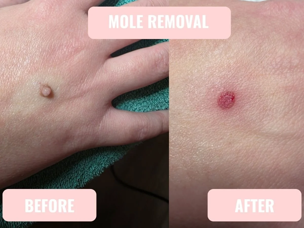Mole removal before and after