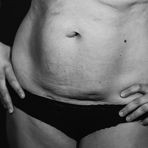 A close-up of a woman's midsection showing her belly, navel, and lower abdomen with caesarean section scar, hands resting on hips in black and white.