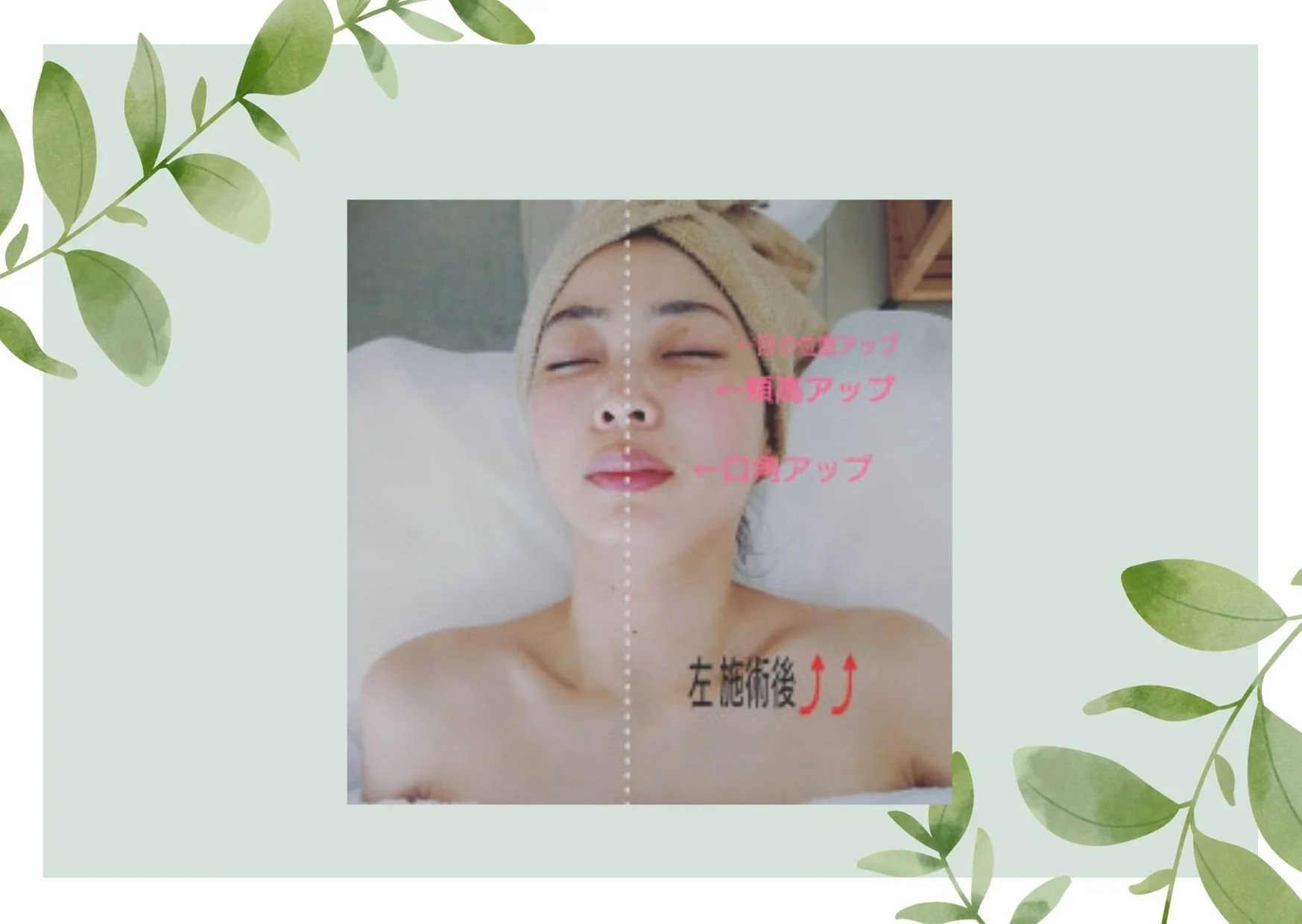 ハリ&リフトアップ