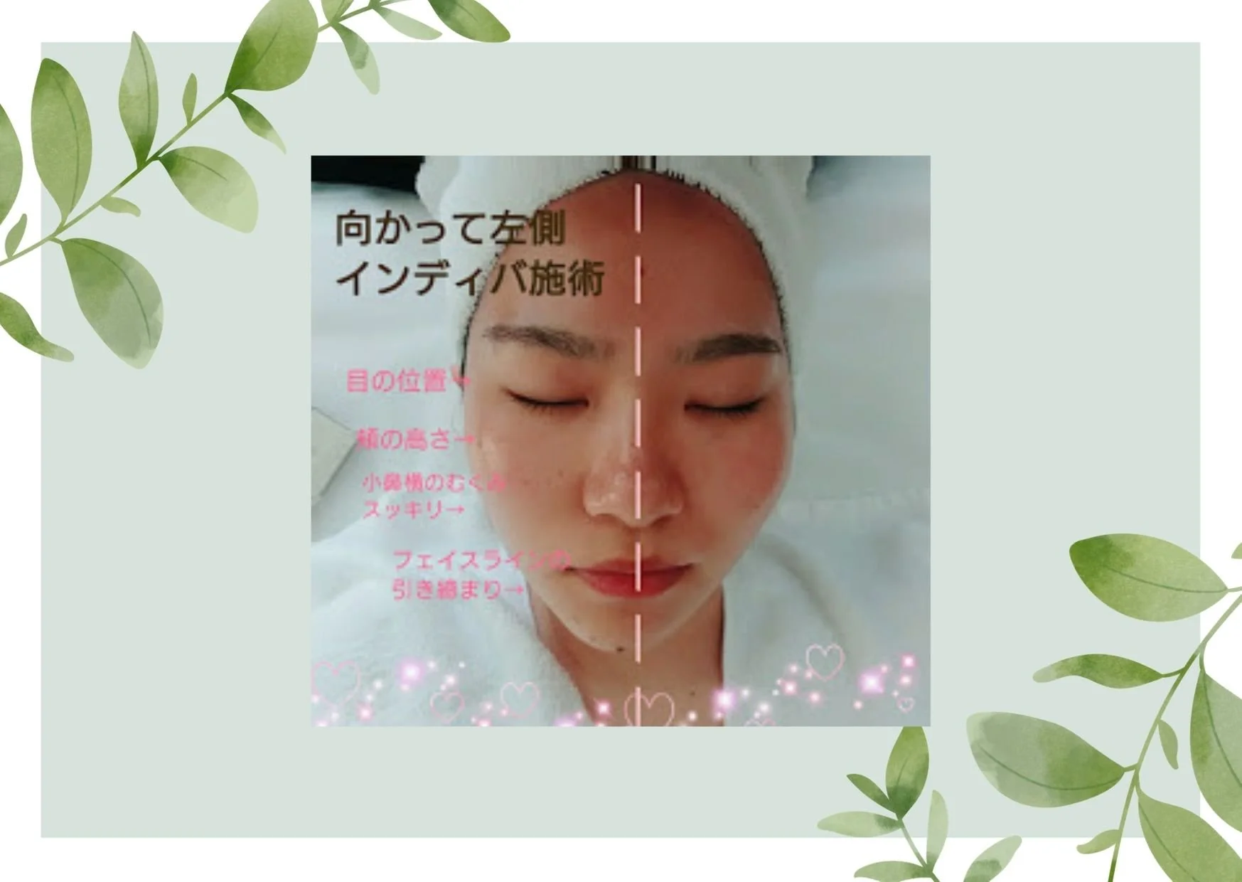 ほうれい線、眉間のしわの改善 (8).jpg