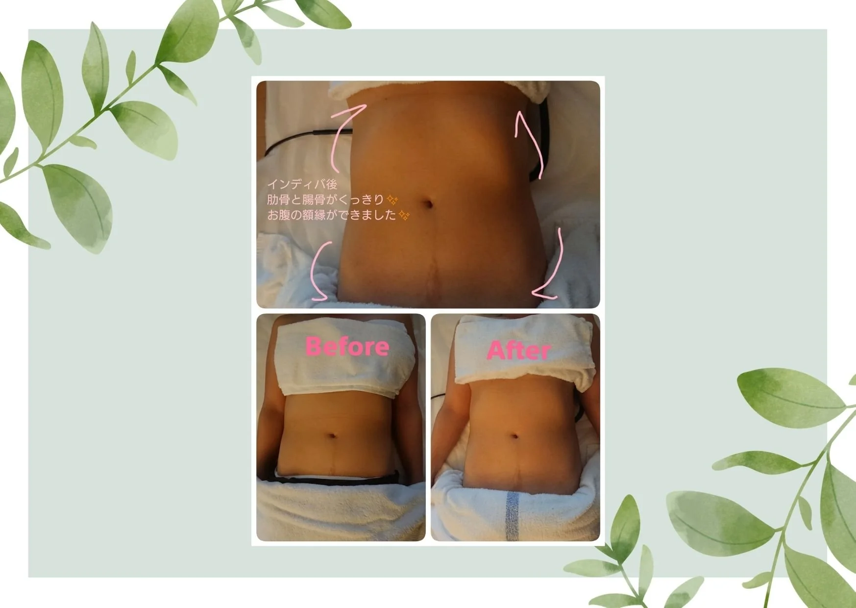 ほうれい線、眉間のしわの改善 (2).jpg