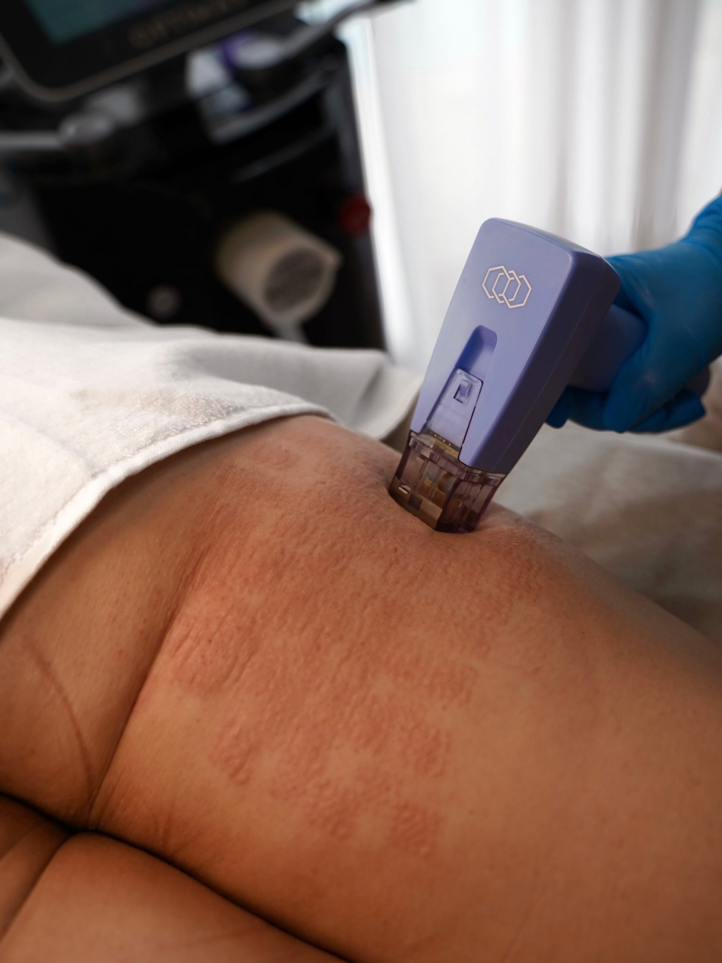 Cyber Monday ! 20% off Morpheus8 &mdash; body &amp; face treatments today only!

Call or message us to book