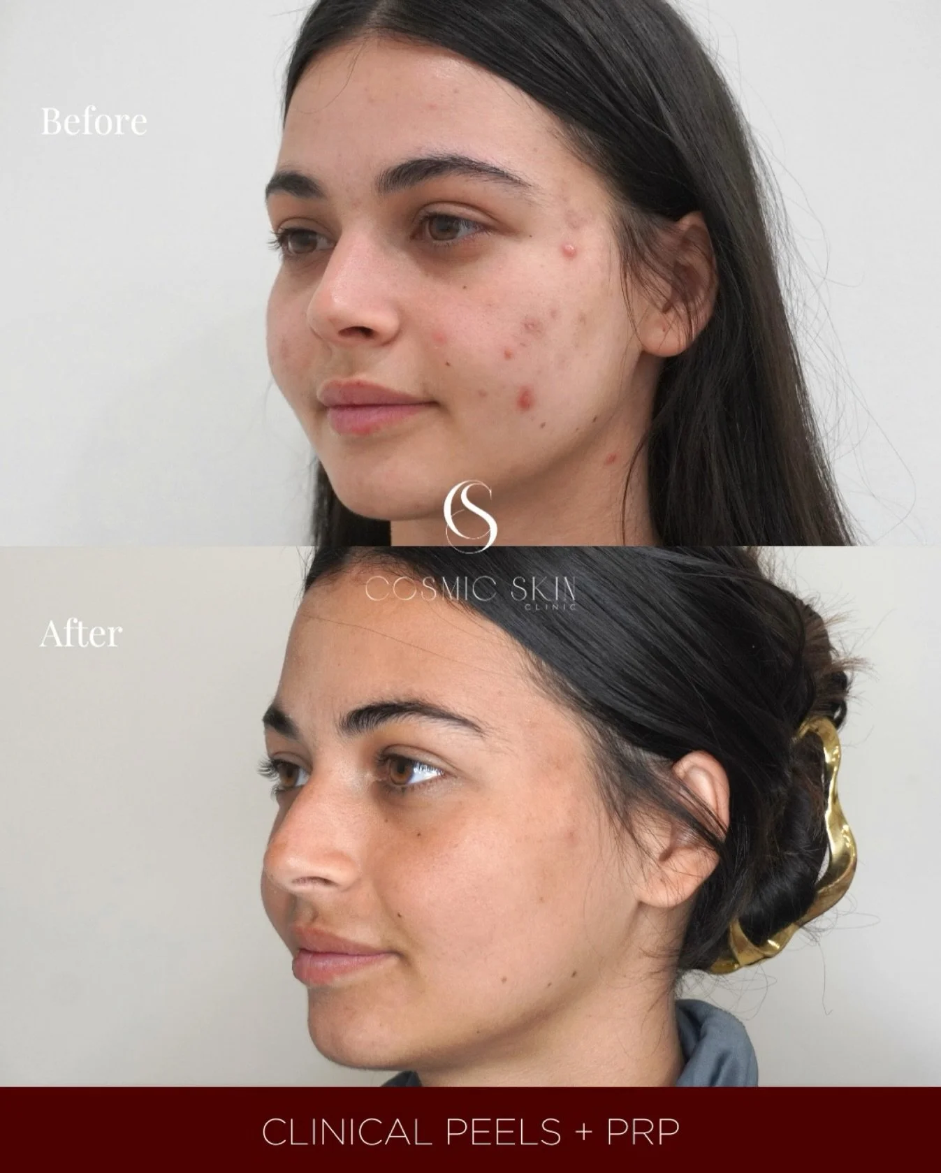 This PRP transformation shows what happens when we activate the skin&rsquo;s own healing power. Using concentrated growth factors from your own plasma, PRP helps refine texture, soften fine lines, and enhance overall radiance. Natural rejuvenation, v