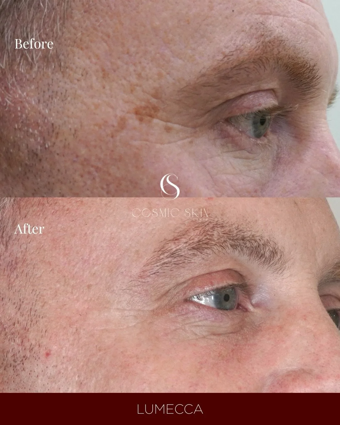 Unwanted pigmentation can be safely and efficiently treated with Lumecca, a powerful IPL technology that precisely targets pigmented lesions to improve skin clarity and restore a more uniform complexion.