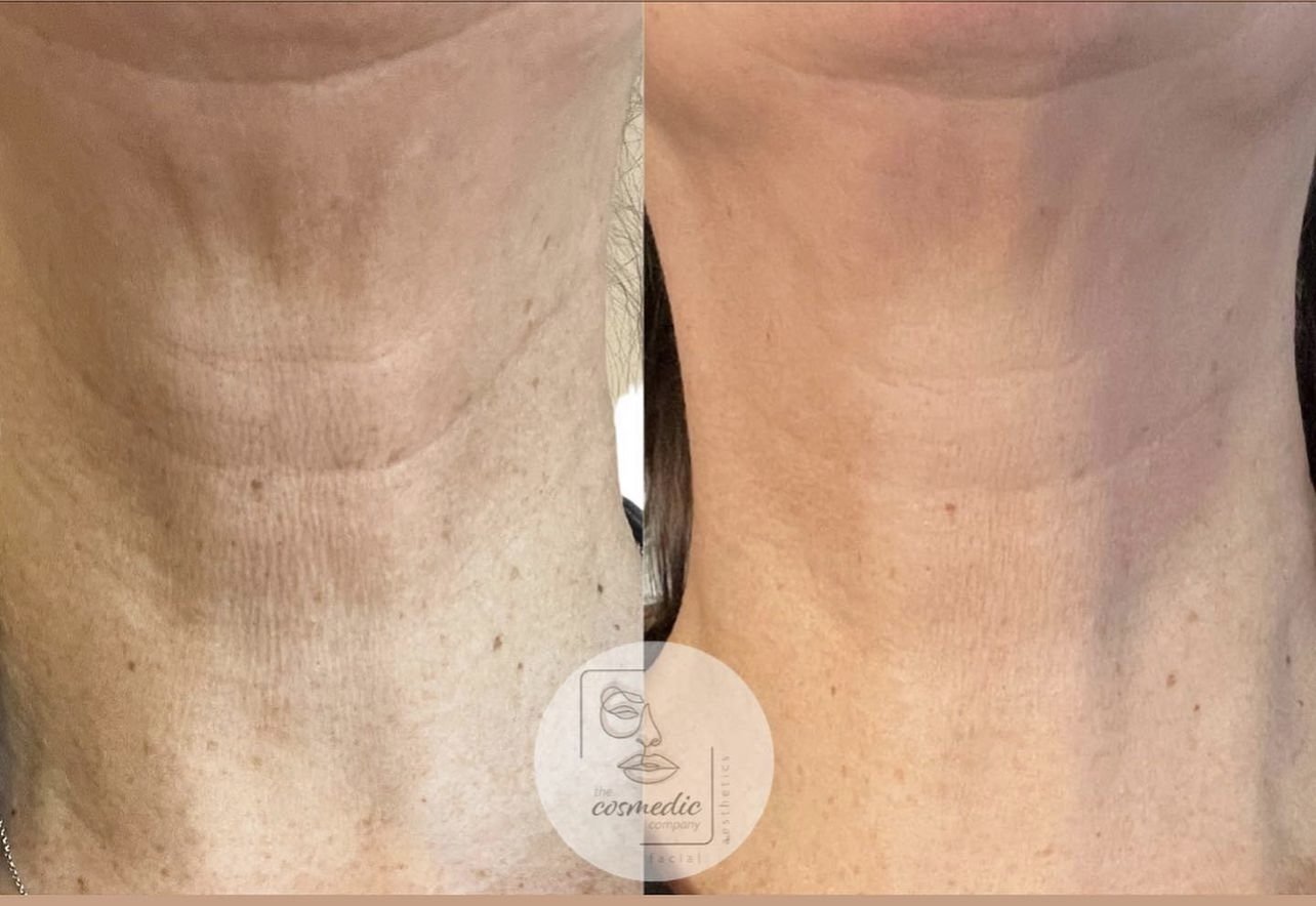 PROFHILO-before-and-after-08.jpg