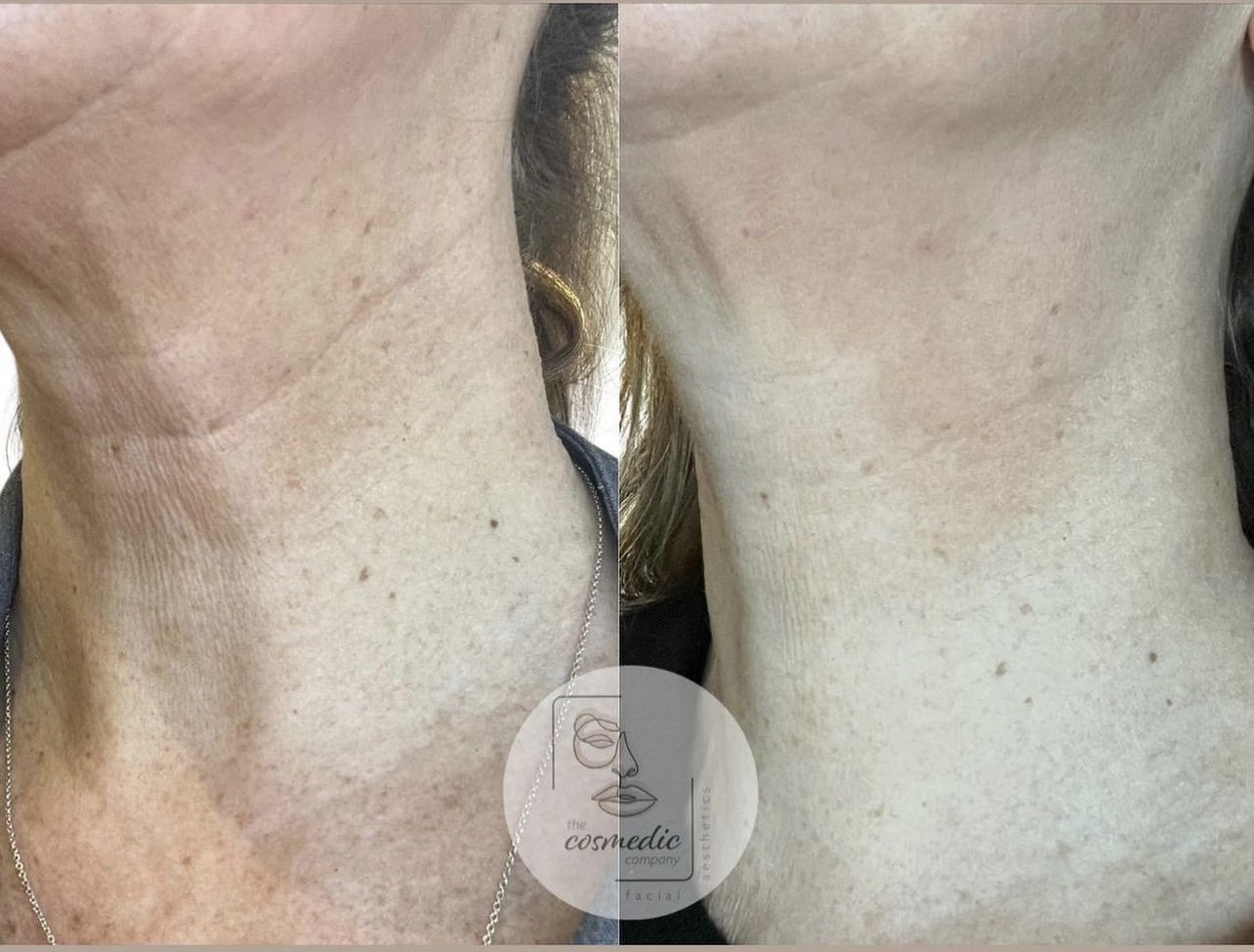 PROFHILO-before-and-after-09.jpg