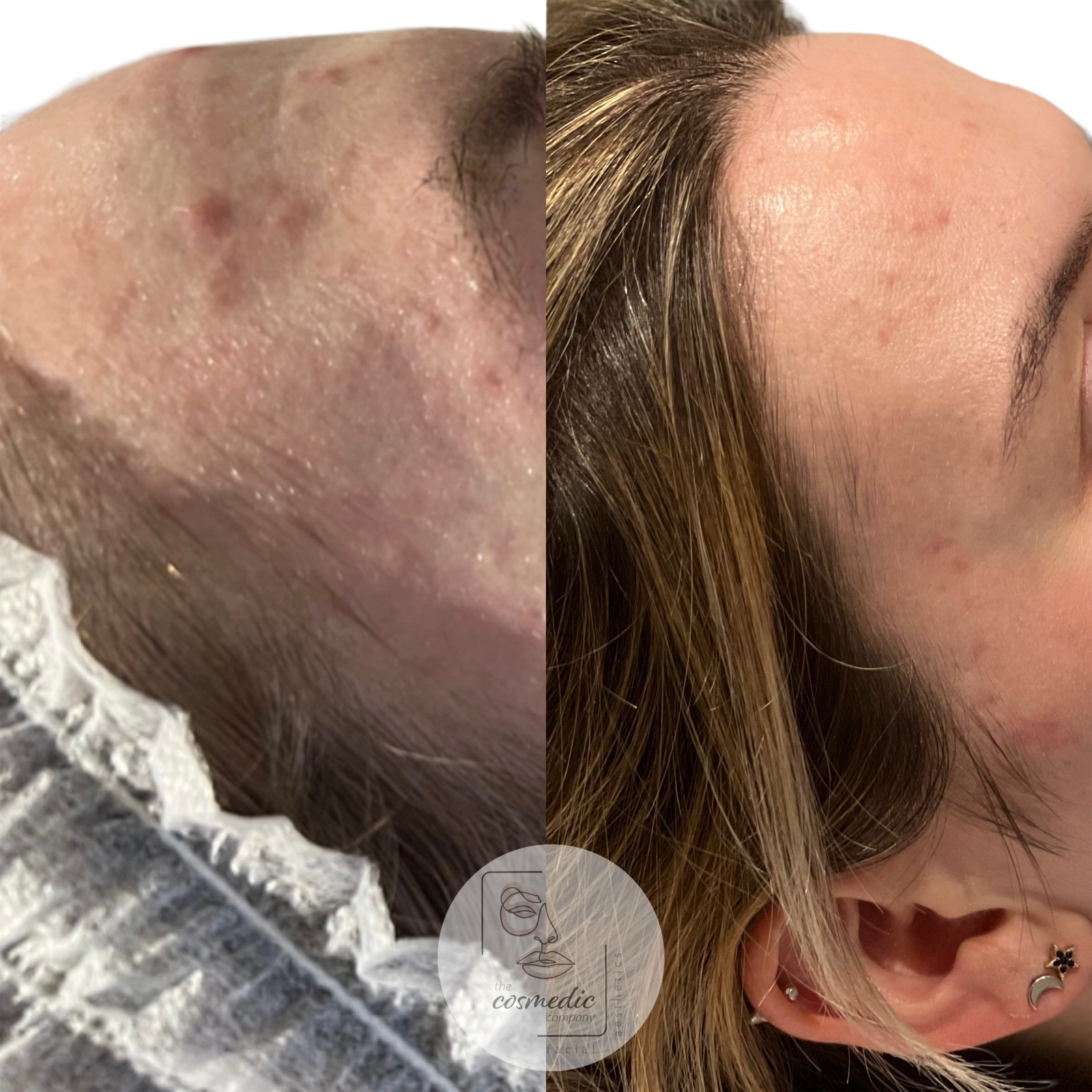 microneedling-before-and-after-05.png