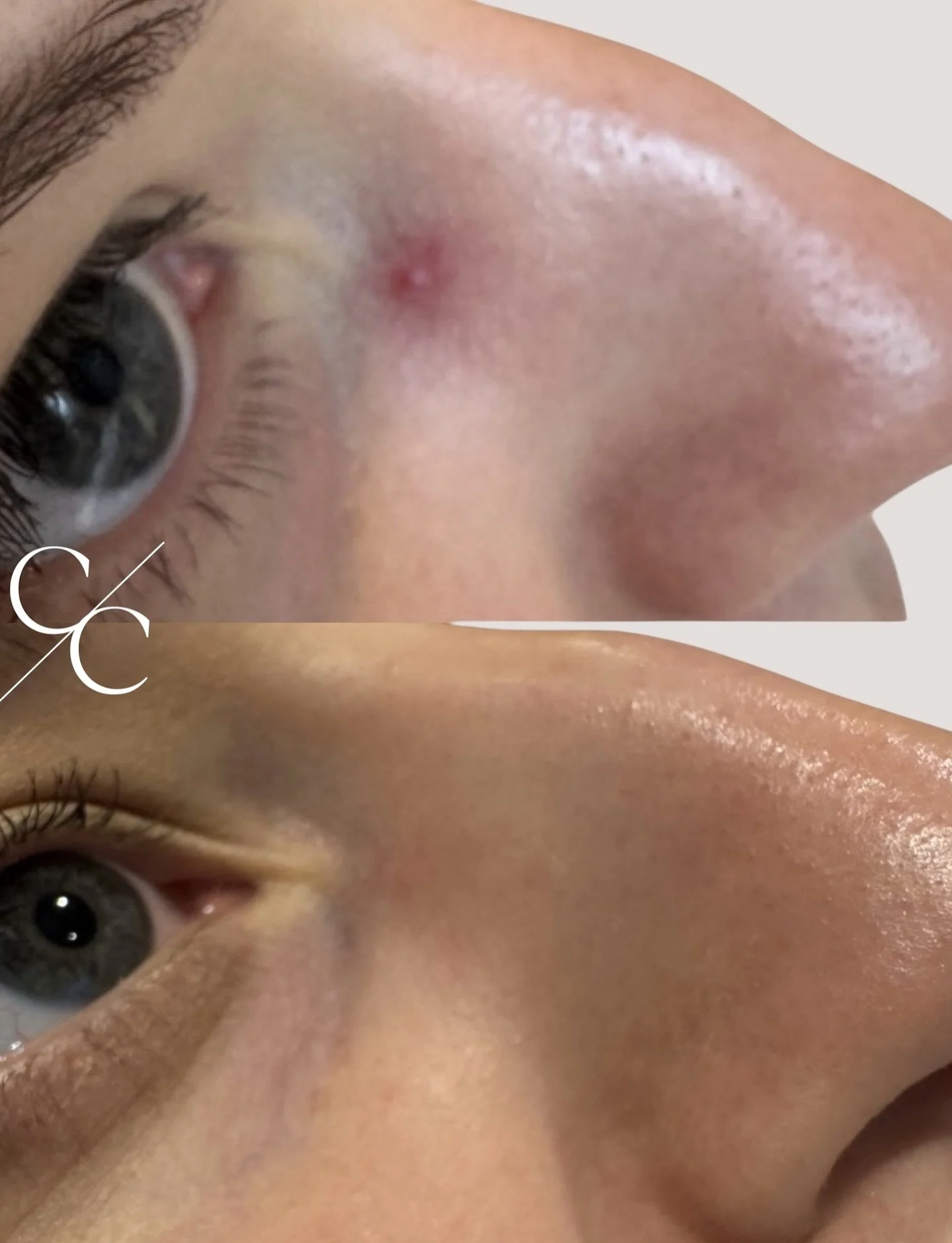 ✨ Real Results with Lumecca IPL ✨

Our lovely patient had 2 clusters of veins to either side of the nose, that she was keen to reduce the appearance of. 
These incredible before and afters show just how effective Lumecca IPL can be for treating threa