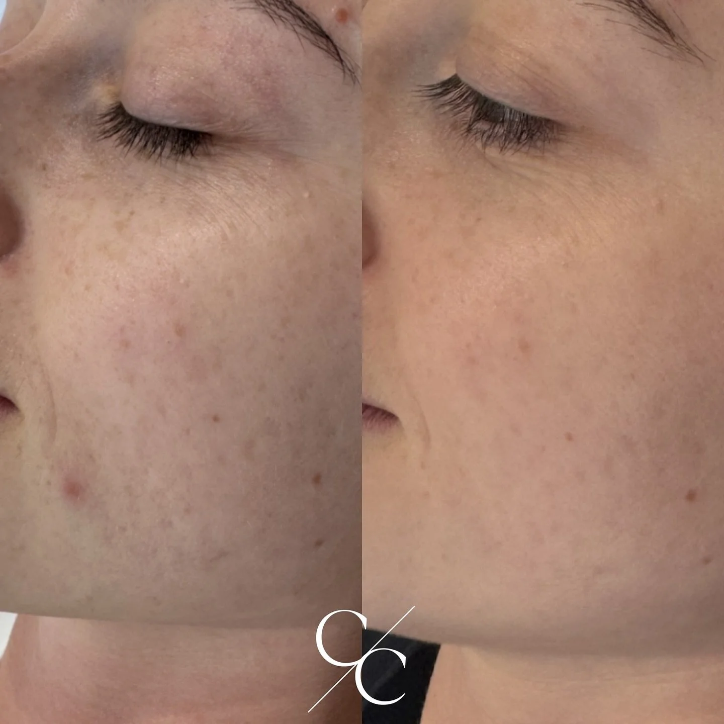 1 SkinPen microneedling treatment!
The beginning of a course of treatments, but I couldn&rsquo;t wait to 
share ✨

My beautiful bride to be began her skin prep journey a couple of months ago, for her wedding next year (it&rsquo;s never too early) 
He