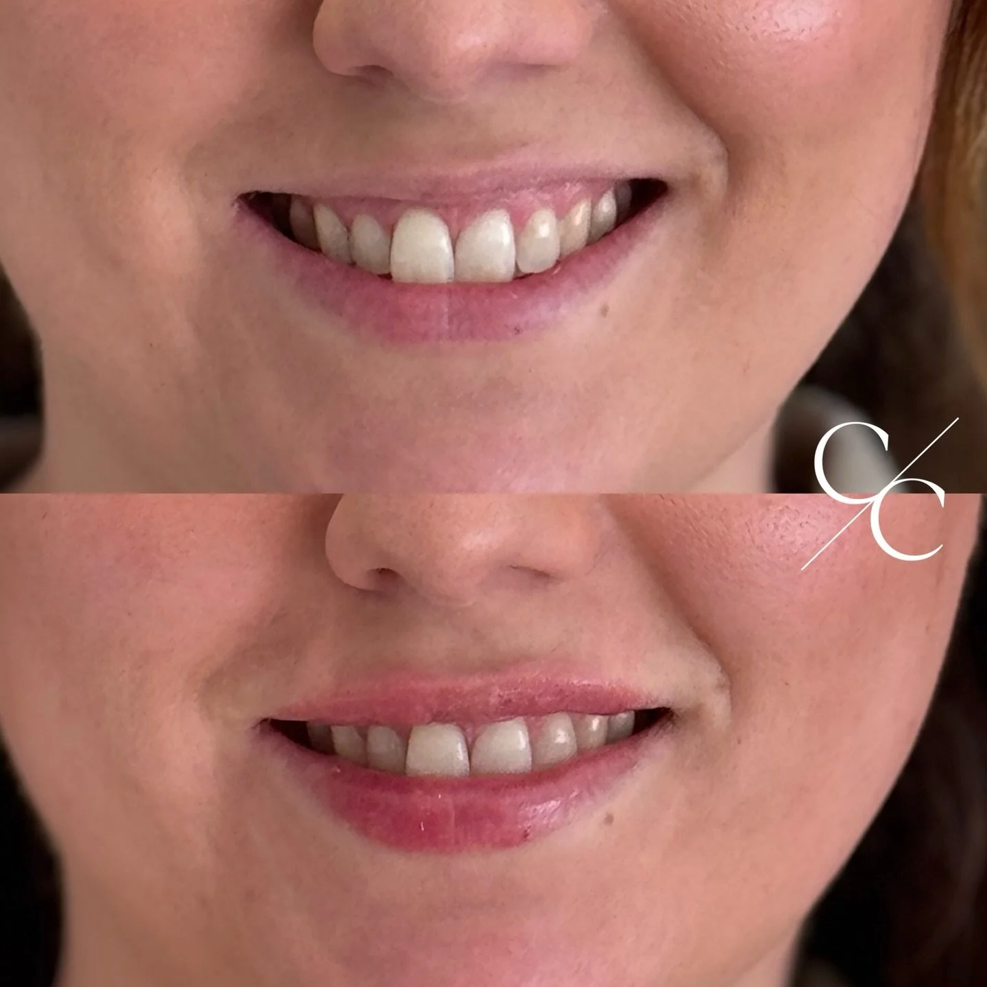 A beautifully subtle lip transformation &hellip; but definitely a thoughtful one 🤍

Lip asymmetry is not just about the lips themselves, the causes run deeper than the surface
Muscle movement, dental structure, natural anatomy, even expression patte