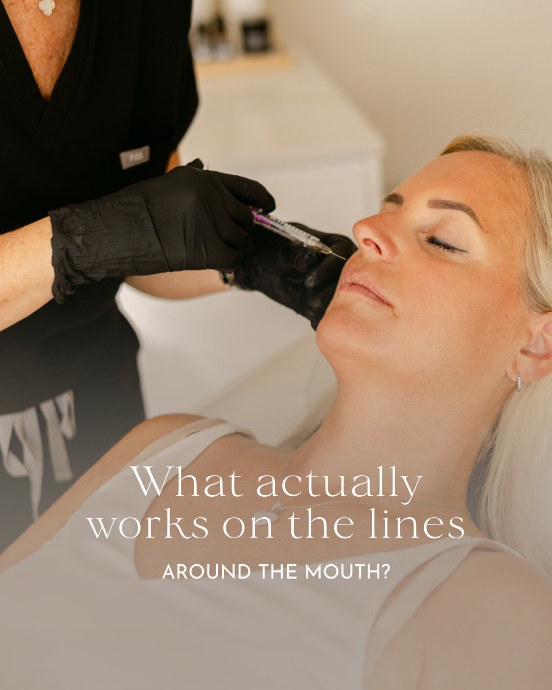 &ldquo;Can you just fill these lines around my mouth?&rdquo; It&rsquo;s one of the most common things I&rsquo;m asked, and the answer is usually no, not how you might expect.

Here&rsquo;s the thing most people don&rsquo;t realise: the lines around t