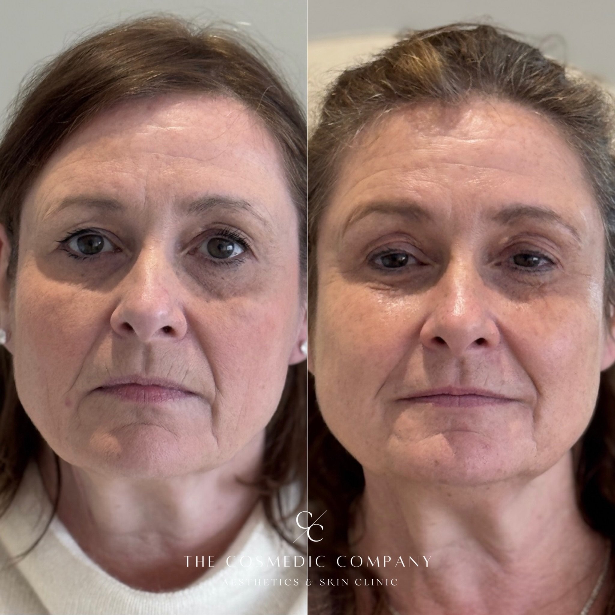 A lovely example of what Profhilo can do for skin quality ✨️

No change to her features, nothing added or reshaped. Just skin that looks healthier, firmer and better hydrated than it did a few weeks earlier.

Profhilo isn&rsquo;t a filler, and it doe