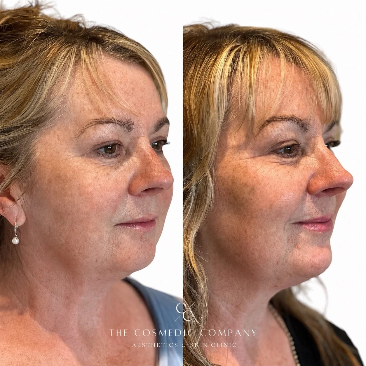 Sometimes the biggest difference comes from treating the areas that support the face, rather than chasing lines themselves.

For this patient, we used Teoxane dermal filler in the cheeks and chin to restore support and improve overall facial balance.