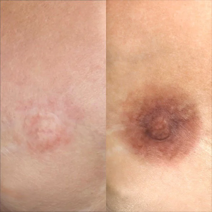 Areola Restoration (NHS cover-up)