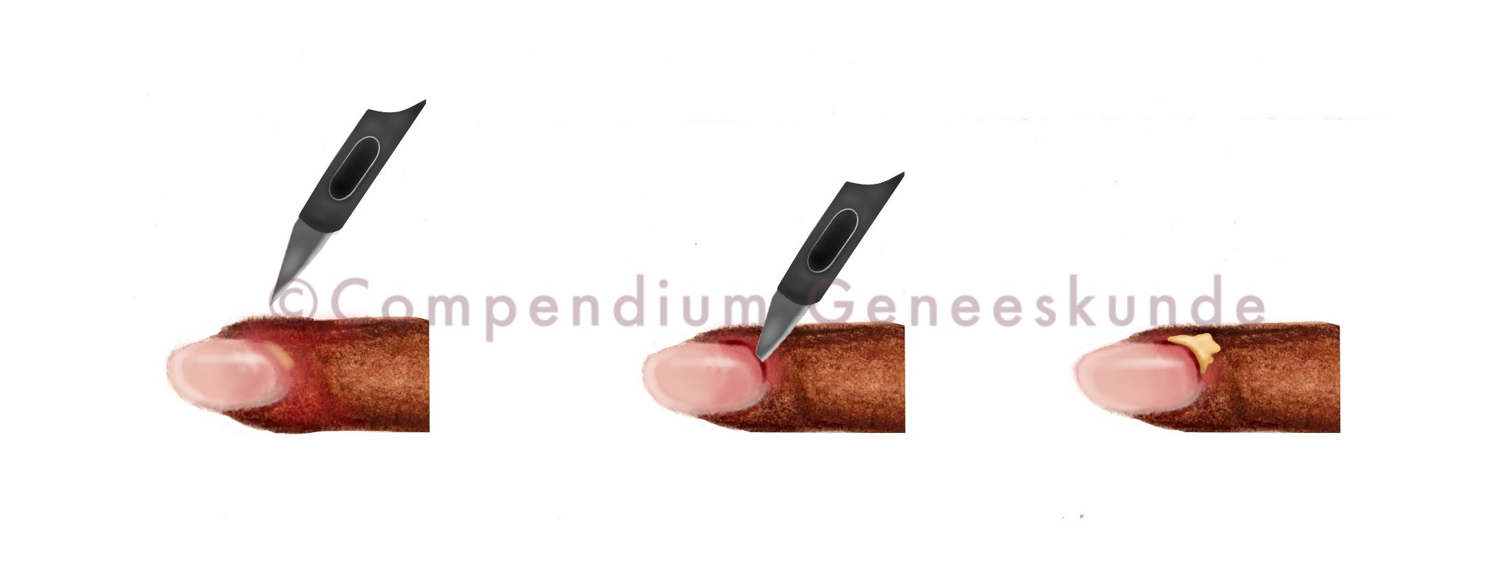 Paronychia_incisie_(Aangepast).jpg