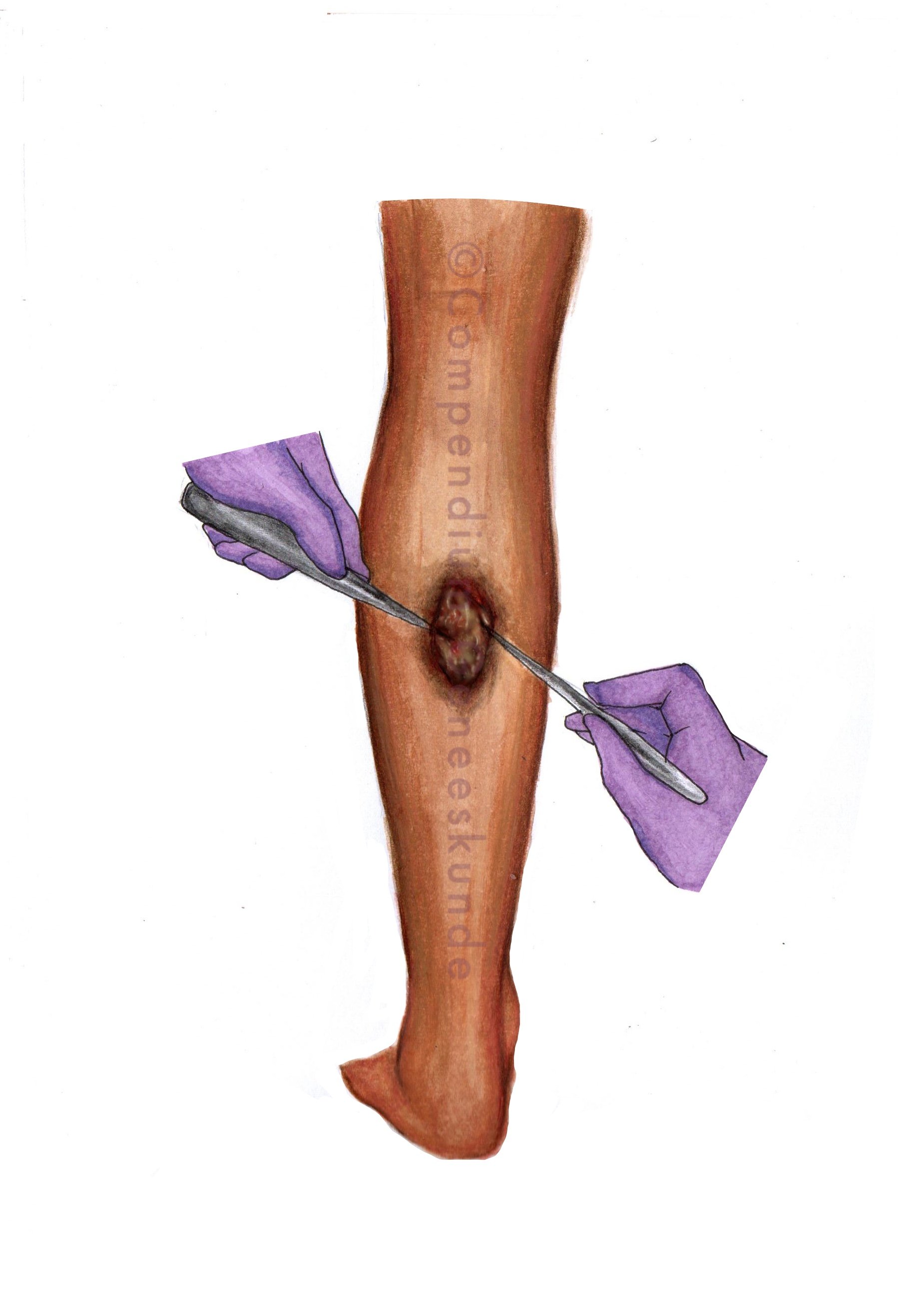 Necrotectomie_(aangepast).jpg