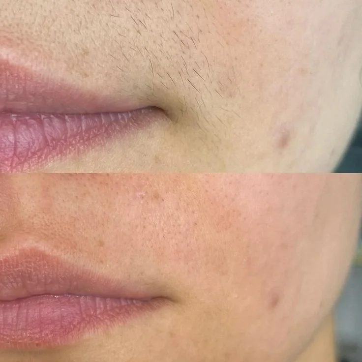 Professional sugaring hair removal South Etobicoke