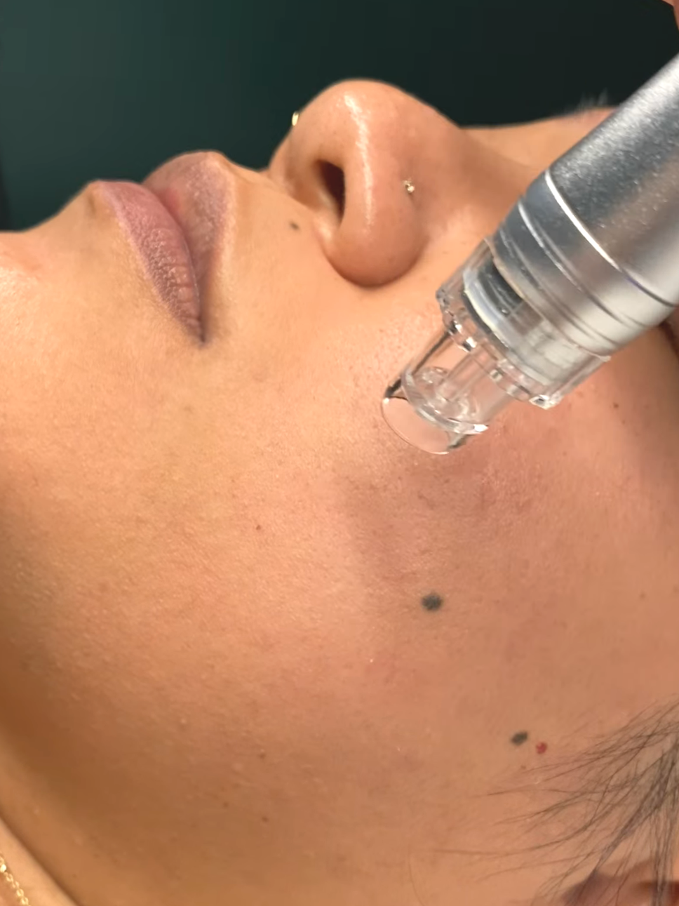 Best facial for acne scars-The Queensway