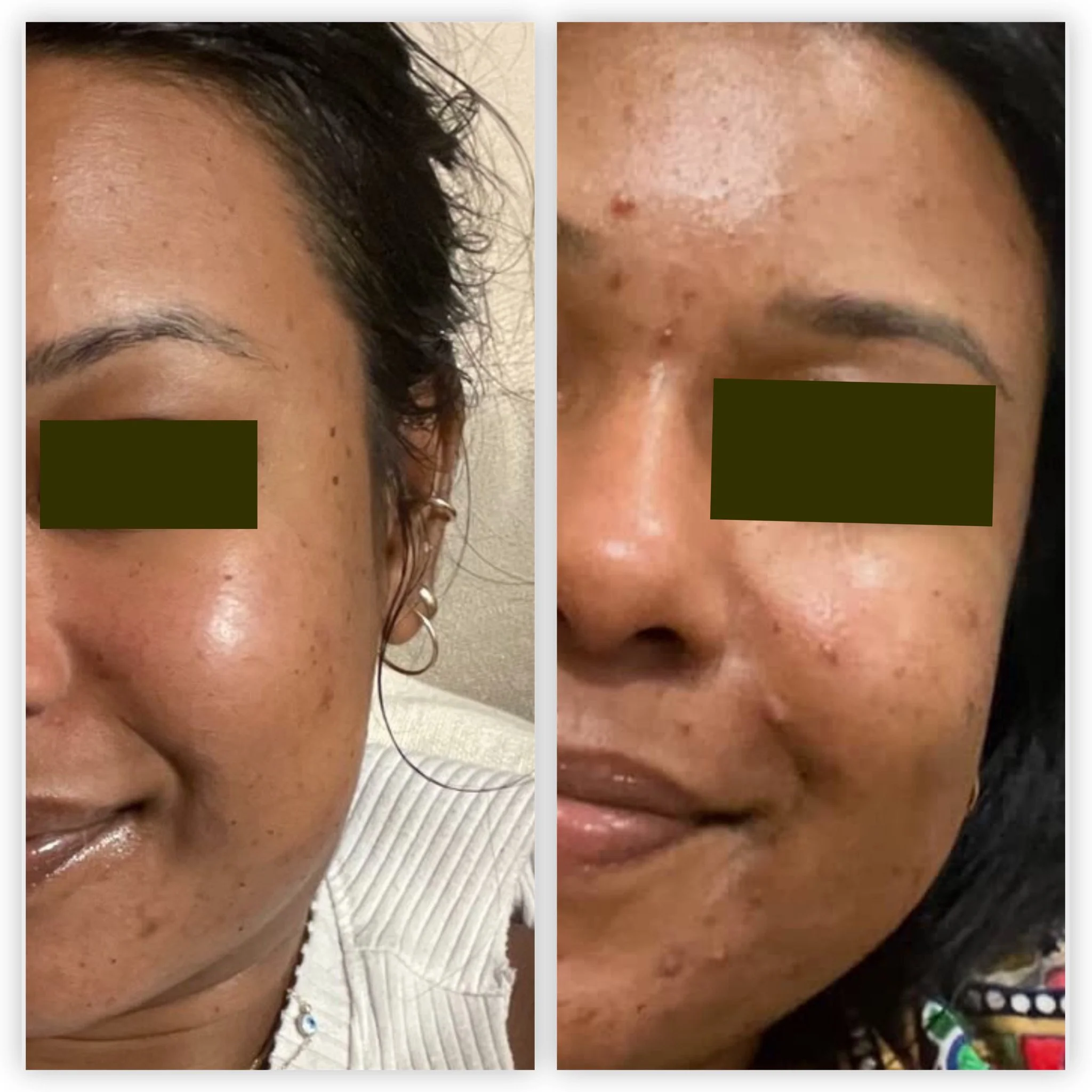 Acne Facial Royal York, Acne solutions, How to clear acne