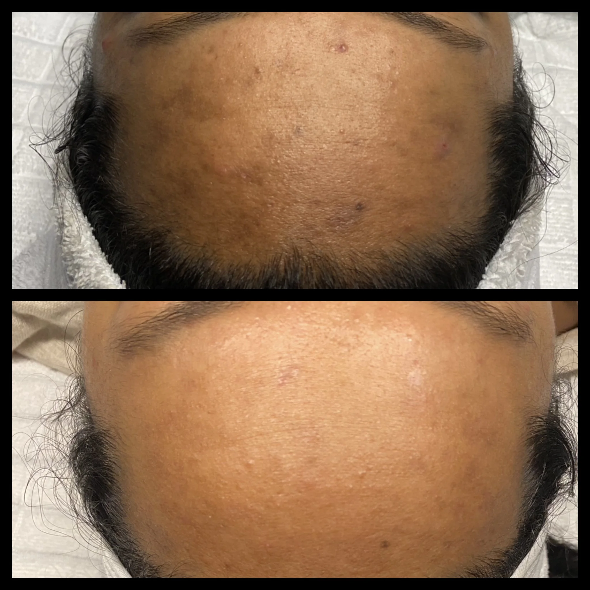 Hyperpigmentation treatment the Queensway, How to fade pigmentation