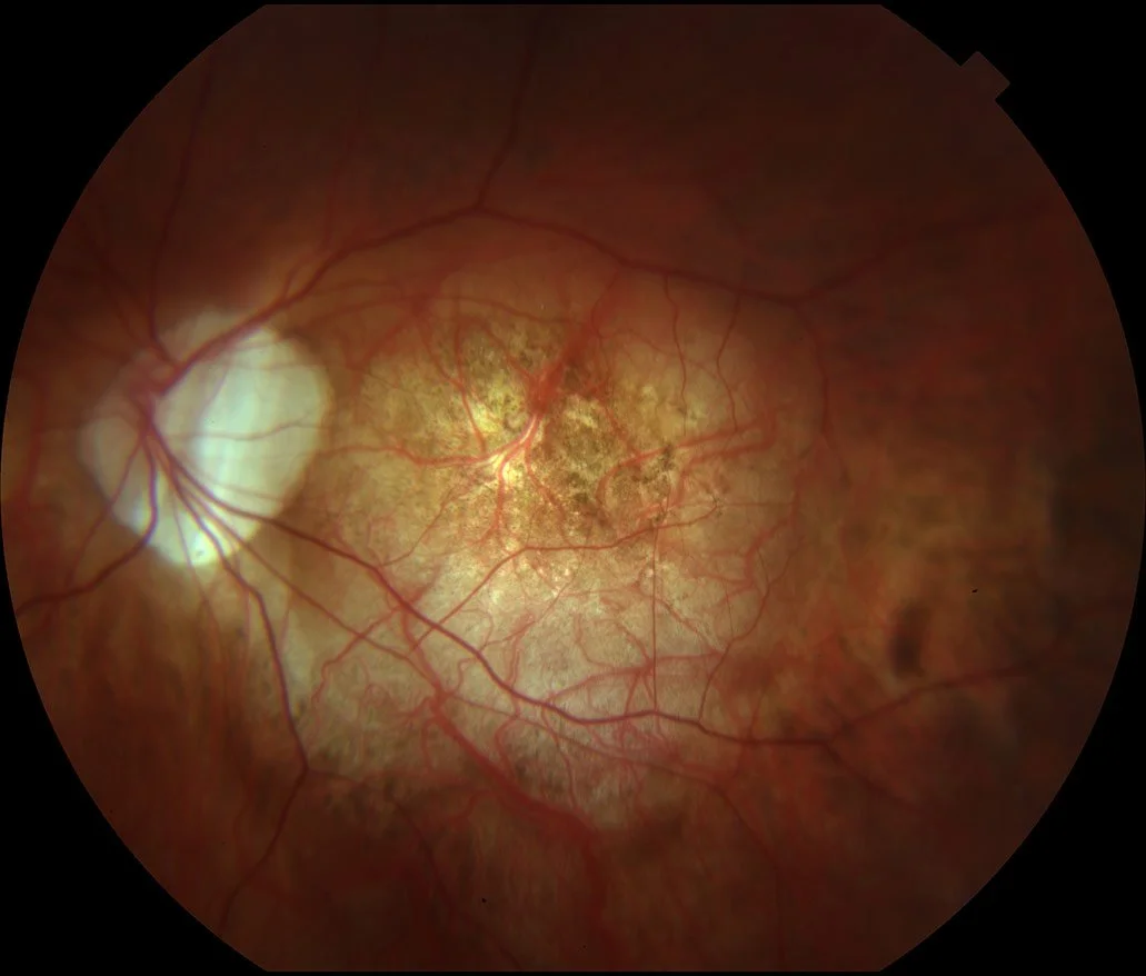 A detailed view of a human retina showing blood vessels, the optic disc on the left, and signs of retinal degeneration or disease in the central area.