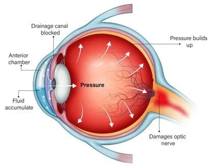 Diagram of an eye with increased pressure pressing against the optic nerve, showing fluid buildup, blocked drainage canal, and damage to the optic nerve.