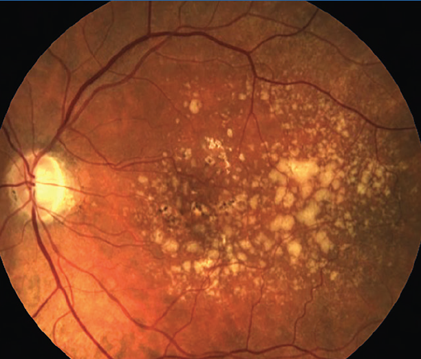 Retinal scan showing yellowish deposit spots indicating possible age-related macular degeneration.