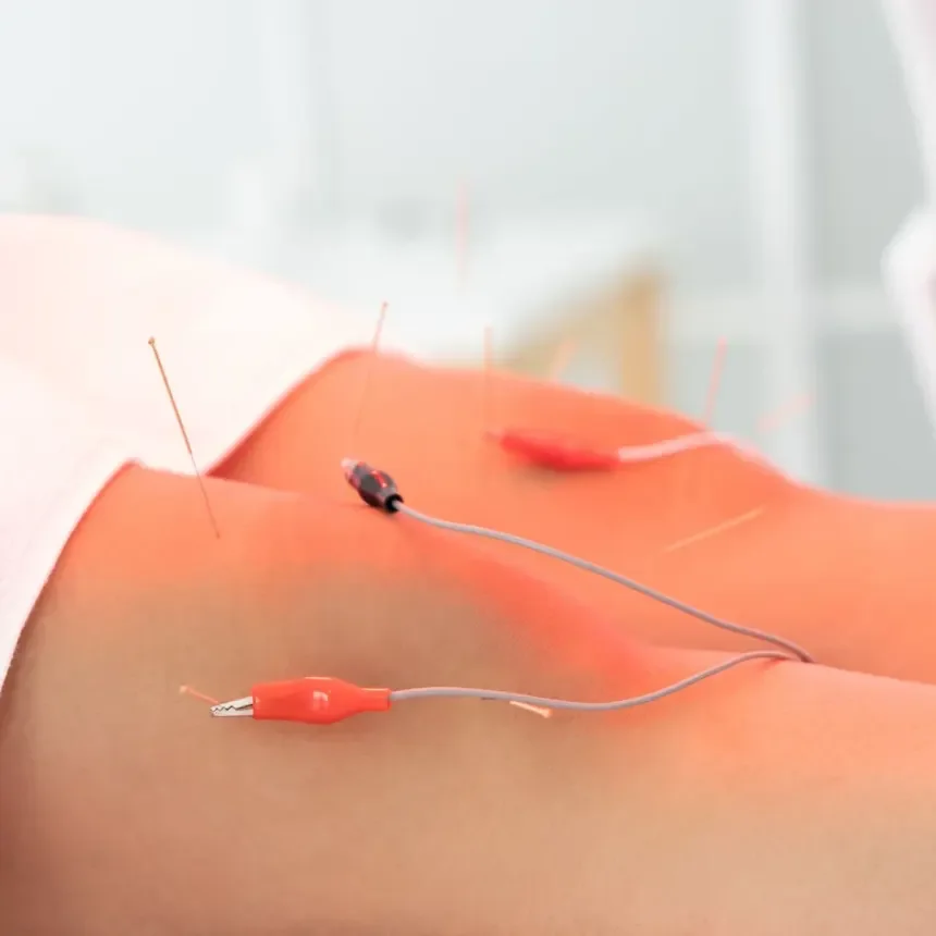 Electrical Stimulation Acupuncture London Ontario